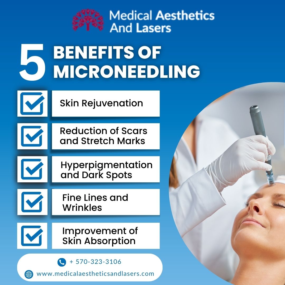 Micro needling treatment in Lewisburg