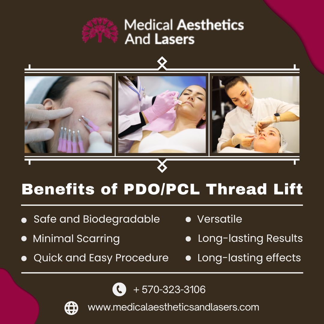 PDO Thread Lift Procedure, Benefits, and Side Effects